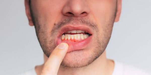 Vaping and Oral Health: Can Vaping Cause Bleeding Gums?