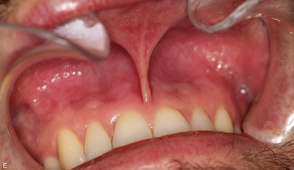 Nicotine Pouches and Oral Health: The Latest Evidence on the Risks and Their Solutions